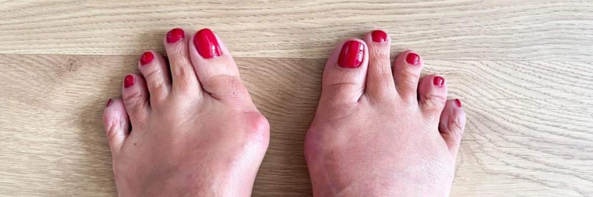 Hallux valgus